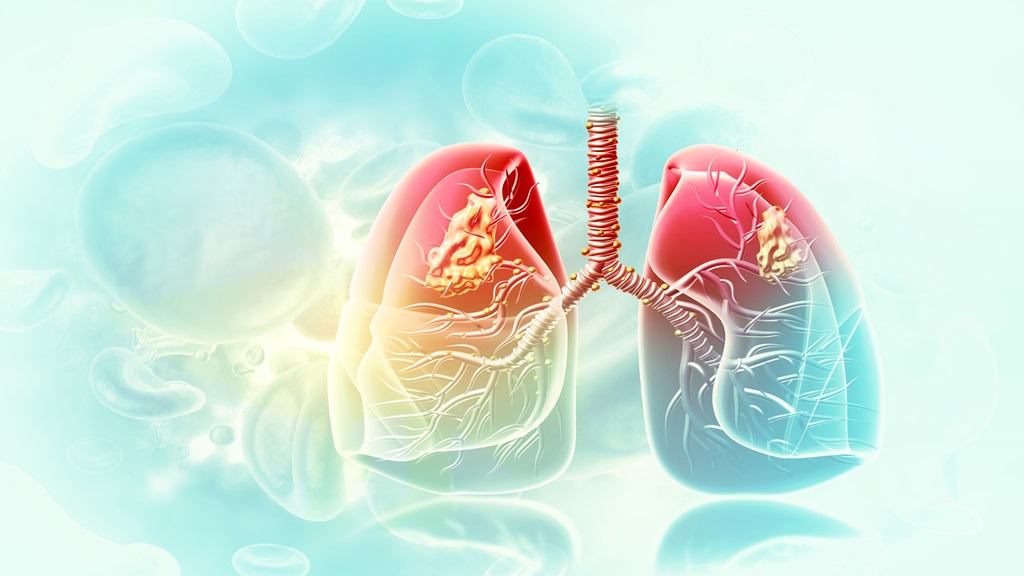What is asthma? Causes, Symptoms and Homeopathic Treatments