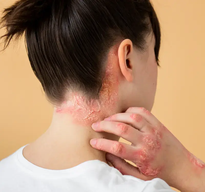 Homeopathy Treatment for Fungal Infection