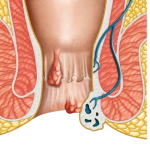 1617884254700x400-px_0013_Hemorrhoid-Surgery-Symptoms-Types-and-Aftercare-.jpg__1_-removebg-preview