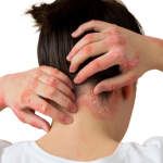 ASCLEPEION-Psoriasis-removebg-preview