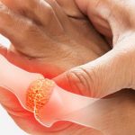 Foot-Gout-Treatment-in-Arizona-1000x480