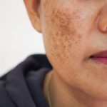 pigmentation-1024x768