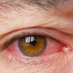 what-is-dry-eye-symptoms-treatment-causes-722x406