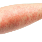what-is-eczema-atopic-dermatitis-symptoms-causes-diagnosis-treatment-prevention-01-722x406-removebg-preview